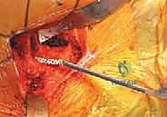 عوامل خطر كسر الفخذ