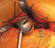 مفصل ثنائي القطب