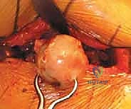 رأب نصف مفصل الورك لكسور عنق الفخذ: دليل شامل لاستعادة الحركة مع الأستاذ الدكتور محمد هطيف في صنعاء