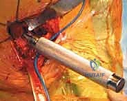 صورة توضيحية لـ رأب نصف مفصل الورك لكسور عنق الفخذ: دليل شامل لاستعادة الحركة مع الأستاذ الدكتور محمد هطيف في صنعاء