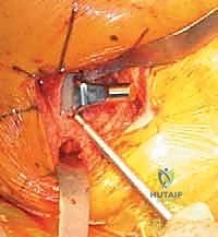 صورة توضيحية لـ رأب نصف مفصل الورك لكسور عنق الفخذ: دليل شامل لاستعادة الحركة مع الأستاذ الدكتور محمد هطيف في صنعاء