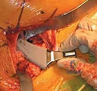 صورة توضيحية لـ رأب نصف مفصل الورك لكسور عنق الفخذ: دليل شامل لاستعادة الحركة مع الأستاذ الدكتور محمد هطيف في صنعاء