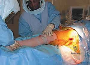 صورة طبية: رأب نصف مفصل الورك لكسور عنق الفخذ: دليل شامل لاستعادة الحركة مع الأستاذ الدكتور محمد هطيف في صنعاء