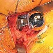 صورة توضيحية لـ رأب نصف مفصل الورك لكسور عنق الفخذ: دليل شامل لاستعادة الحركة مع الأستاذ الدكتور محمد هطيف في صنعاء