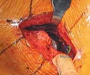 صورة توضيحية لـ رأب نصف مفصل الورك لكسور عنق الفخذ: دليل شامل لاستعادة الحركة مع الأستاذ الدكتور محمد هطيف في صنعاء