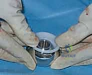 صورة توضيحية لـ رأب نصف مفصل الورك لكسور عنق الفخذ: دليل شامل لاستعادة الحركة مع الأستاذ الدكتور محمد هطيف في صنعاء