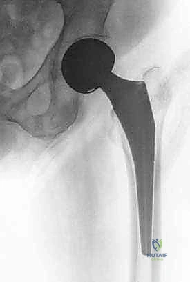 صورة طبية: رأب نصف مفصل الورك لكسور عنق الفخذ: دليل شامل لاستعادة الحركة مع الأستاذ الدكتور محمد هطيف في صنعاء