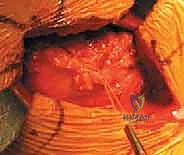 صورة طبية: رأب نصف مفصل الورك لكسور عنق الفخذ: دليل شامل لاستعادة الحركة مع الأستاذ الدكتور محمد هطيف في صنعاء