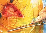 صورة طبية: رأب نصف مفصل الورك لكسور عنق الفخذ: دليل شامل لاستعادة الحركة مع الأستاذ الدكتور محمد هطيف في صنعاء