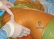 صورة طبية: رأب نصف مفصل الورك لكسور عنق الفخذ: دليل شامل لاستعادة الحركة مع الأستاذ الدكتور محمد هطيف في صنعاء