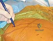 صورة طبية: رأب نصف مفصل الورك لكسور عنق الفخذ: دليل شامل لاستعادة الحركة مع الأستاذ الدكتور محمد هطيف في صنعاء