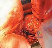 صورة طبية: رأب نصف مفصل الورك لكسور عنق الفخذ: دليل شامل لاستعادة الحركة مع الأستاذ الدكتور محمد هطيف في صنعاء