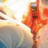 صورة طبية: رأب نصف مفصل الورك لكسور عنق الفخذ: دليل شامل لاستعادة الحركة مع الأستاذ الدكتور محمد هطيف في صنعاء