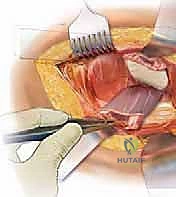 صورة طبية: رأب نصف مفصل الورك لكسور عنق الفخذ: دليل شامل لاستعادة الحركة مع الأستاذ الدكتور محمد هطيف في صنعاء