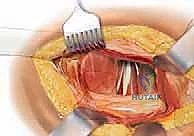 صورة طبية: رأب نصف مفصل الورك لكسور عنق الفخذ: دليل شامل لاستعادة الحركة مع الأستاذ الدكتور محمد هطيف في صنعاء