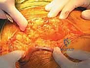 صورة طبية: رأب نصف مفصل الورك لكسور عنق الفخذ: دليل شامل لاستعادة الحركة مع الأستاذ الدكتور محمد هطيف في صنعاء