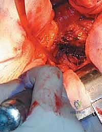 صورة طبية: رأب نصف مفصل الورك لكسور عنق الفخذ: دليل شامل لاستعادة الحركة مع الأستاذ الدكتور محمد هطيف في صنعاء