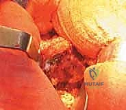 صورة طبية: رأب نصف مفصل الورك لكسور عنق الفخذ: دليل شامل لاستعادة الحركة مع الأستاذ الدكتور محمد هطيف في صنعاء