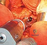 صورة طبية: رأب نصف مفصل الورك لكسور عنق الفخذ: دليل شامل لاستعادة الحركة مع الأستاذ الدكتور محمد هطيف في صنعاء