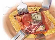 صورة طبية: رأب نصف مفصل الورك لكسور عنق الفخذ: دليل شامل لاستعادة الحركة مع الأستاذ الدكتور محمد هطيف في صنعاء