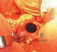 صورة طبية: رأب نصف مفصل الورك لكسور عنق الفخذ: دليل شامل لاستعادة الحركة مع الأستاذ الدكتور محمد هطيف في صنعاء