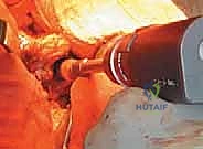 Illustration of hemiarthroplasty of the hip - Dr. Mohammed Hutaif