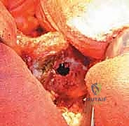 صورة طبية: رأب نصف مفصل الورك لكسور عنق الفخذ: دليل شامل لاستعادة الحركة مع الأستاذ الدكتور محمد هطيف في صنعاء