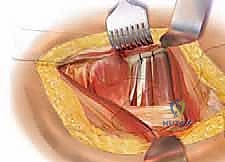 صورة طبية: رأب نصف مفصل الورك لكسور عنق الفخذ: دليل شامل لاستعادة الحركة مع الأستاذ الدكتور محمد هطيف في صنعاء