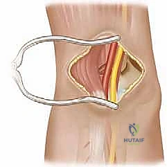صورة توضيحية لـ الرد المفتوح لكسور فوق اللقمة العضدية: دليل شامل للمرضى مع الأستاذ الدكتور محمد هطيف في صنعاء