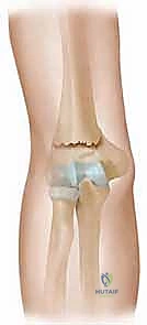 صورة توضيحية لـ الرد المفتوح لكسور فوق اللقمة العضدية: دليل شامل للمرضى مع الأستاذ الدكتور محمد هطيف في صنعاء