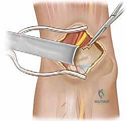 صورة توضيحية لـ الرد المفتوح لكسور فوق اللقمة العضدية: دليل شامل للمرضى مع الأستاذ الدكتور محمد هطيف في صنعاء