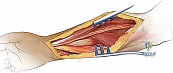 استخدام المسامير الطبية