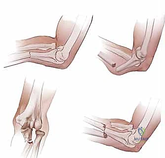 قصة نجاح مريض كسر الساعد