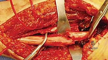 إغلاق الجرح التجميلي