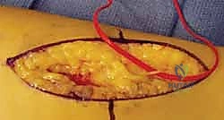 صورة شعاعية بعد العملية