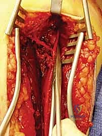 التأكد من ثبات الكسر