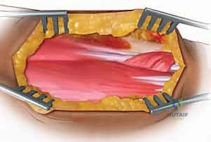 صورة توضيحية لـ كسور الساعد الانبساطية تثبيت داخلي: دليلك الشامل مع الأستاذ الدكتور محمد هطيف في صنعاء