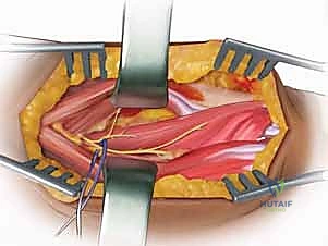 أسباب كسور الساعد