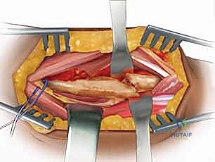أعراض كسر الساعد الانبساطي