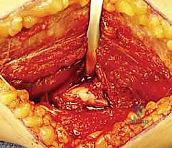 تقييم الكسر المعقد