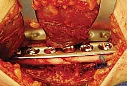 الرد المفتوح للكسر