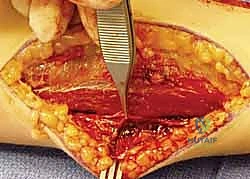 التحضير للعملية الجراحية