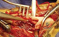 الشق الجراحي الدقيق