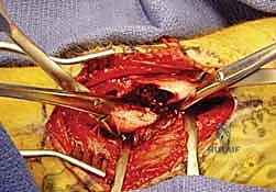 تثبيت الشريحة المعدنية