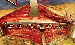 التثبيت بالشرائح والمسامير