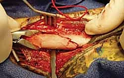 الأستاذ الدكتور محمد هطيف أثناء الجراحة