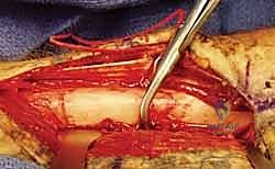 العلاج الطبيعي بعد جراحة الساعد