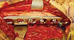 استعادة حركة الكب والبسط