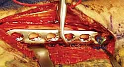 الخيارات العلاجية لكسور الساعد