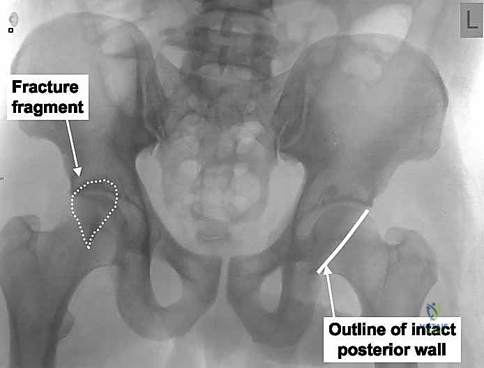 تشريح مفصل الورك والتحضير الجراحي